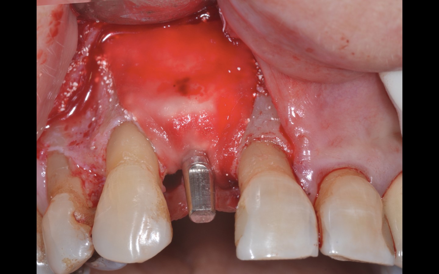 image13 - Reabilitação dento-alveolar com implante Arcsys, enxerto conjuntivo e substituto ósseo Nanosynt