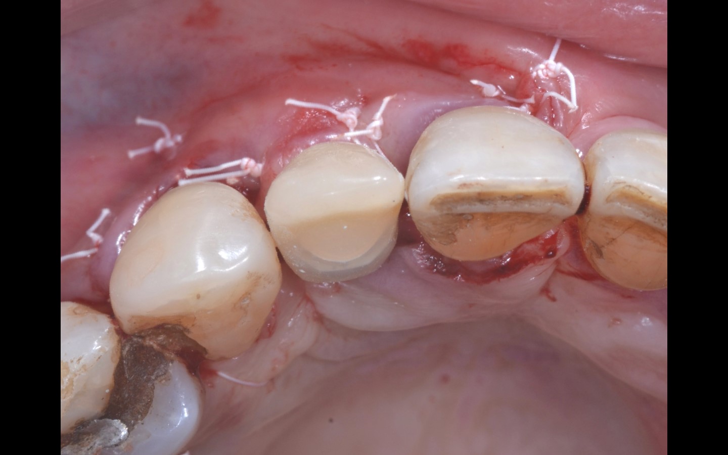 image15 - Reabilitação dento-alveolar com implante Arcsys, enxerto conjuntivo e substituto ósseo Nanosynt