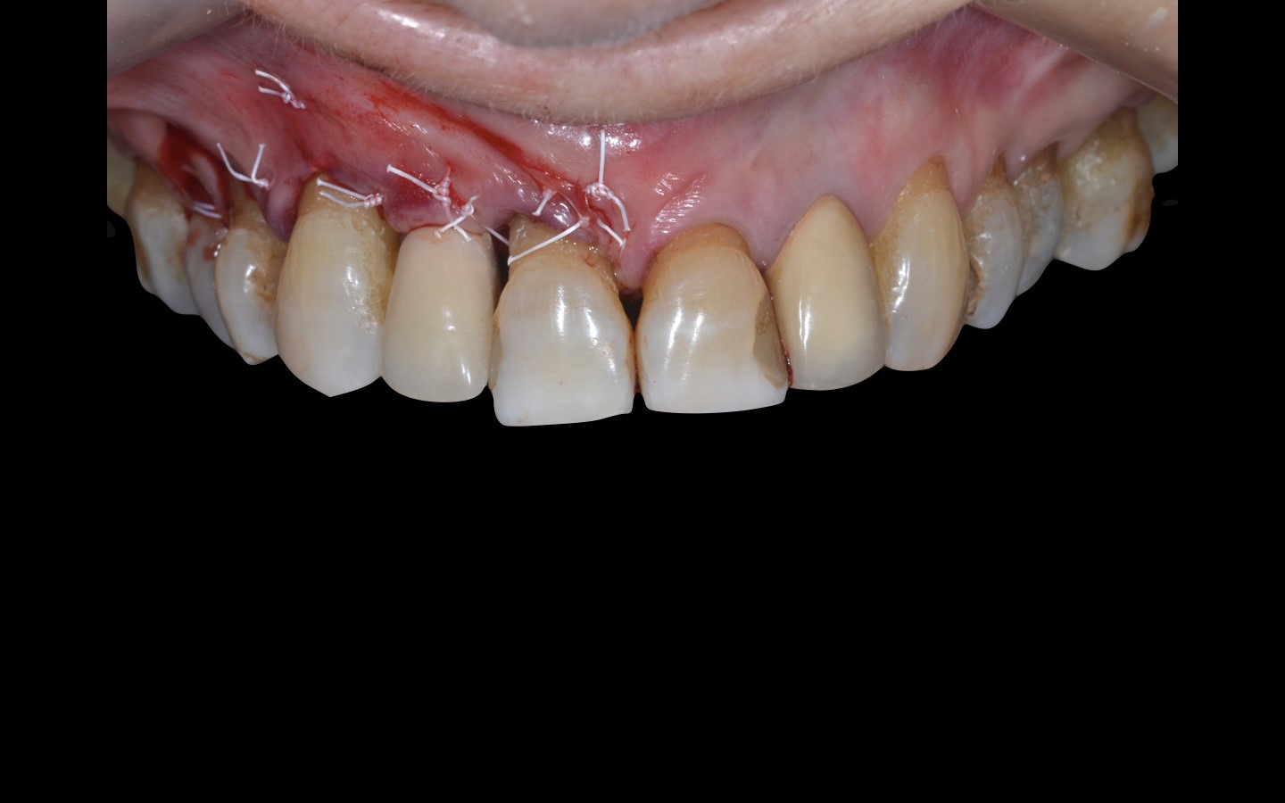 image16 - Reabilitação dento-alveolar com implante Arcsys, enxerto conjuntivo e substituto ósseo Nanosynt