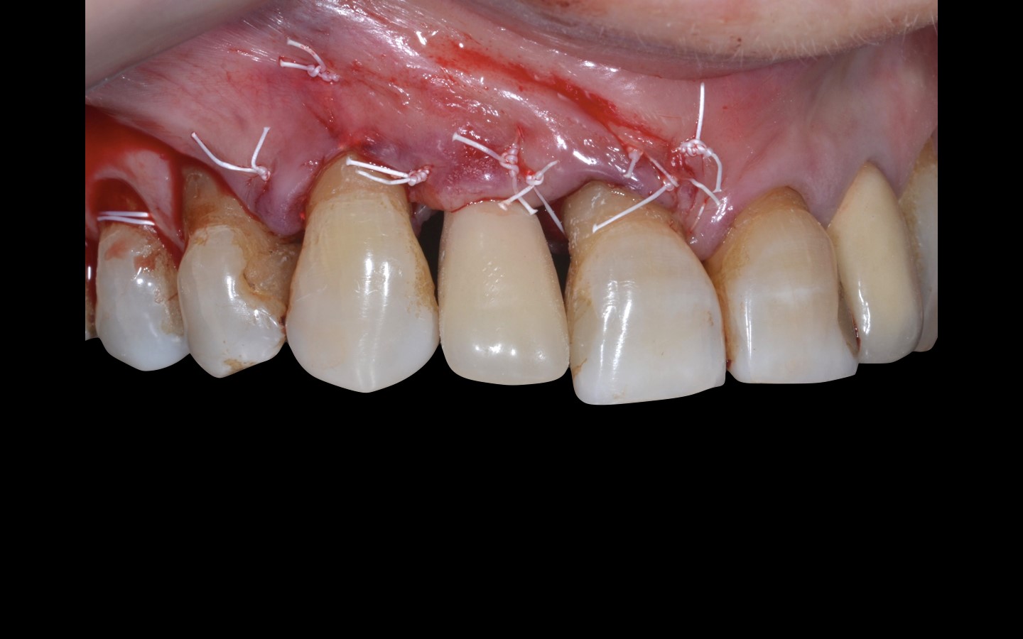 image17 - Reabilitação dento-alveolar com implante Arcsys, enxerto conjuntivo e substituto ósseo Nanosynt