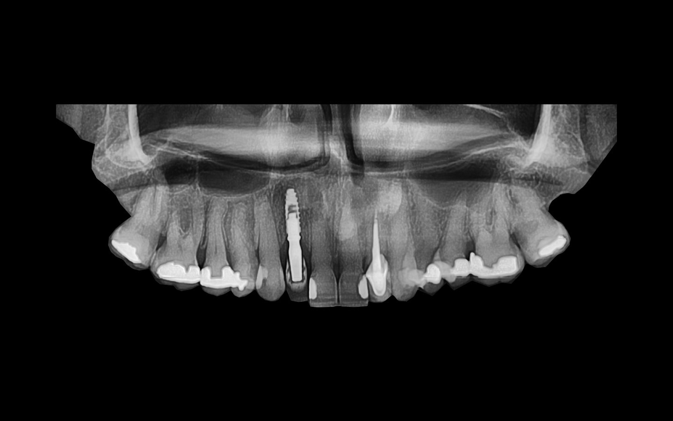 image18 - Reabilitação dento-alveolar com implante Arcsys, enxerto conjuntivo e substituto ósseo Nanosynt