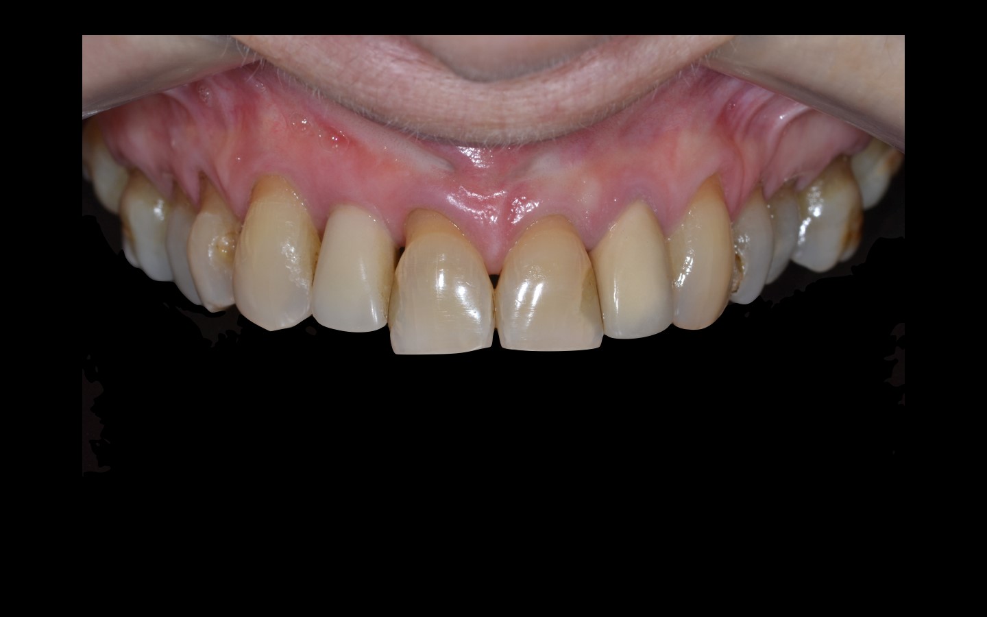 image19 - Reabilitação dento-alveolar com implante Arcsys, enxerto conjuntivo e substituto ósseo Nanosynt