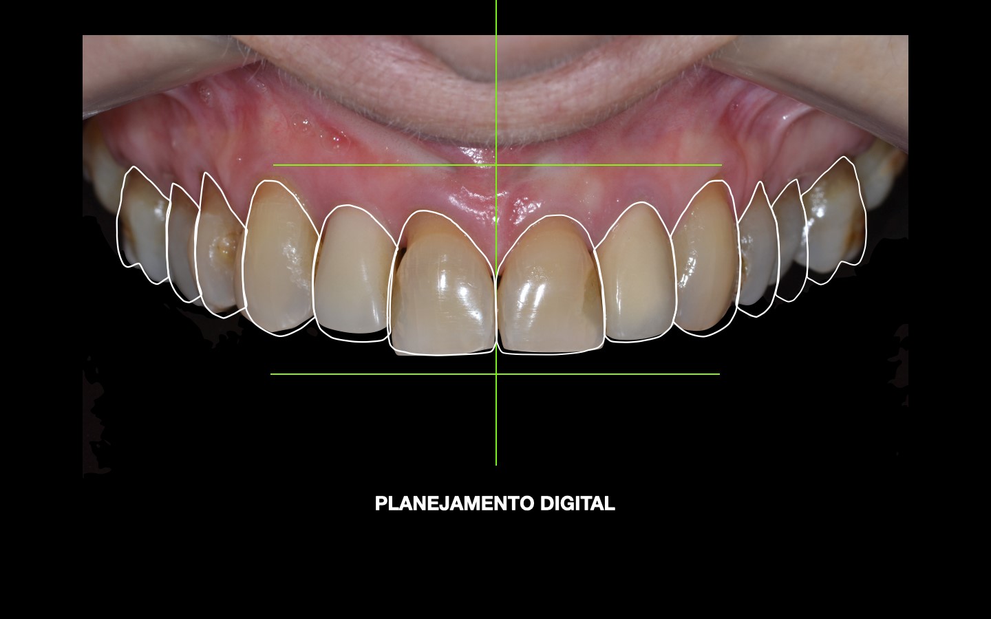 image20 - Reabilitação dento-alveolar com implante Arcsys, enxerto conjuntivo e substituto ósseo Nanosynt