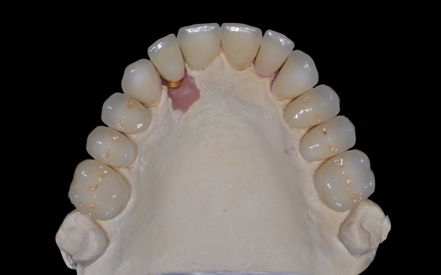 image21 - Reabilitação dento-alveolar com implante Arcsys, enxerto conjuntivo e substituto ósseo Nanosynt