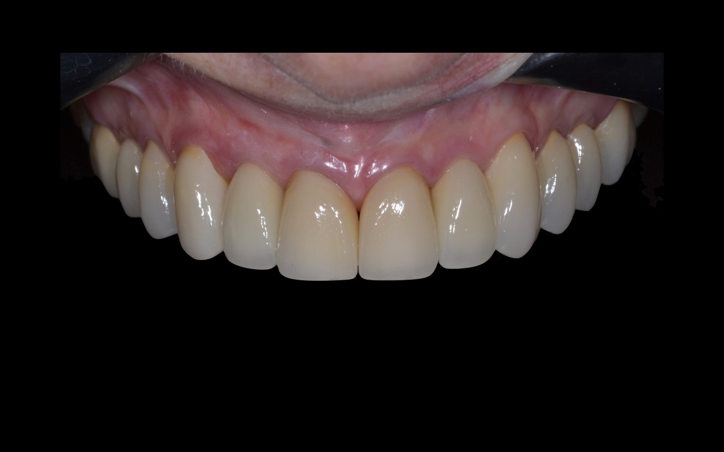 image22 - Reabilitação dento-alveolar com implante Arcsys, enxerto conjuntivo e substituto ósseo Nanosynt
