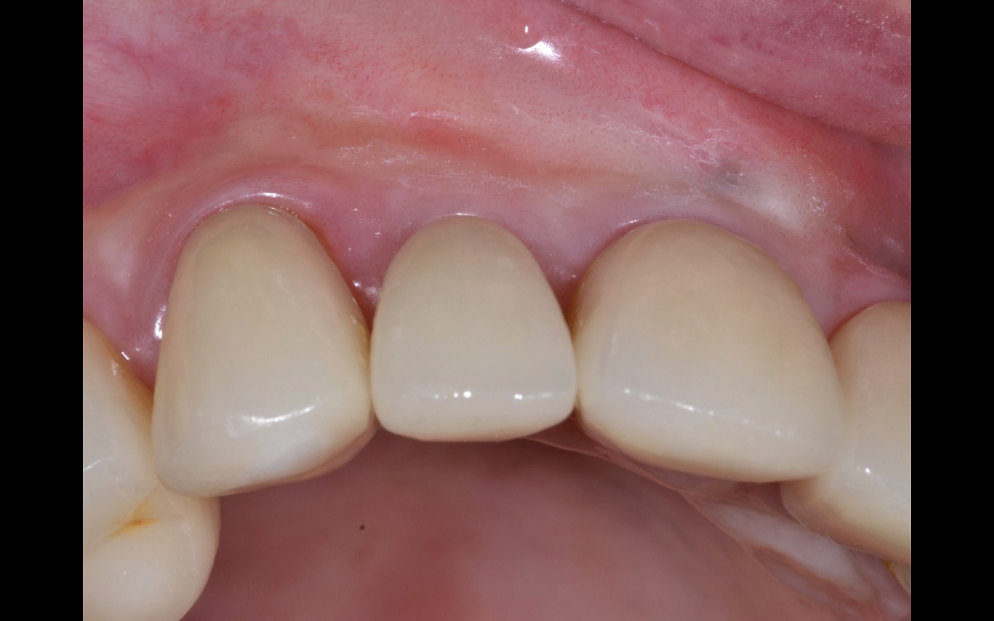 image23 - Reabilitação dento-alveolar com implante Arcsys, enxerto conjuntivo e substituto ósseo Nanosynt