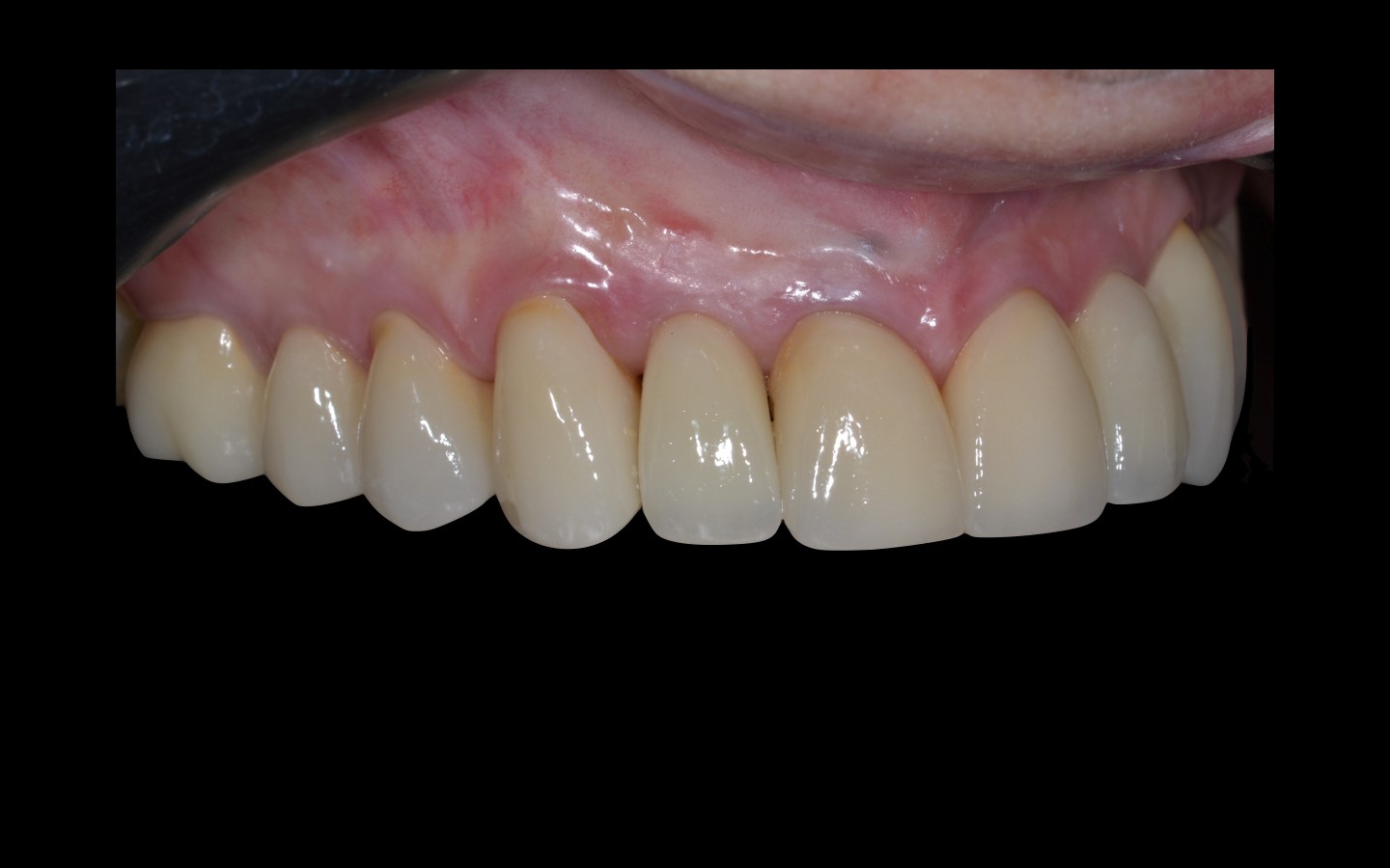 image24 - Reabilitação dento-alveolar com implante Arcsys, enxerto conjuntivo e substituto ósseo Nanosynt