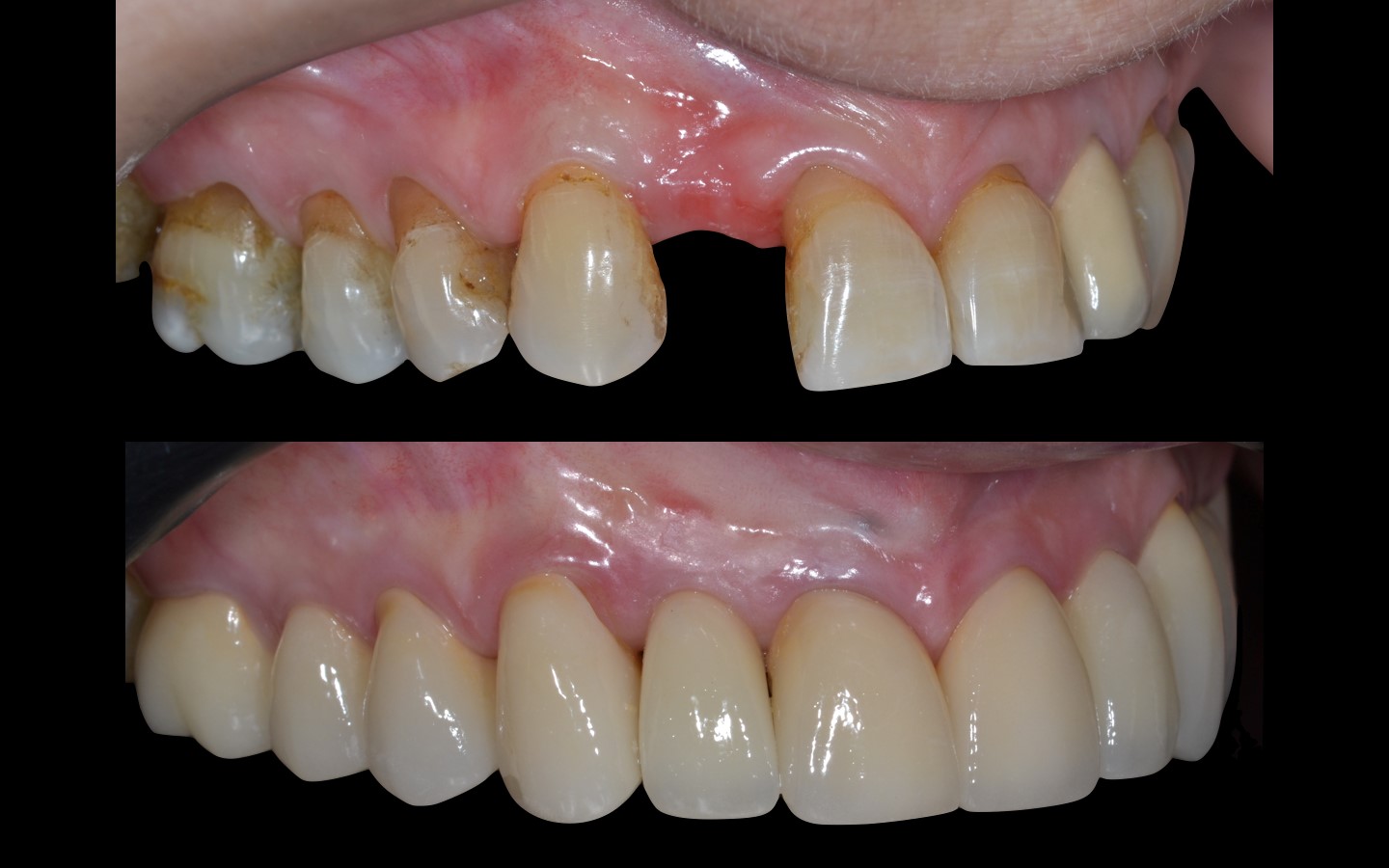 image25 - Reabilitação dento-alveolar com implante Arcsys, enxerto conjuntivo e substituto ósseo Nanosynt