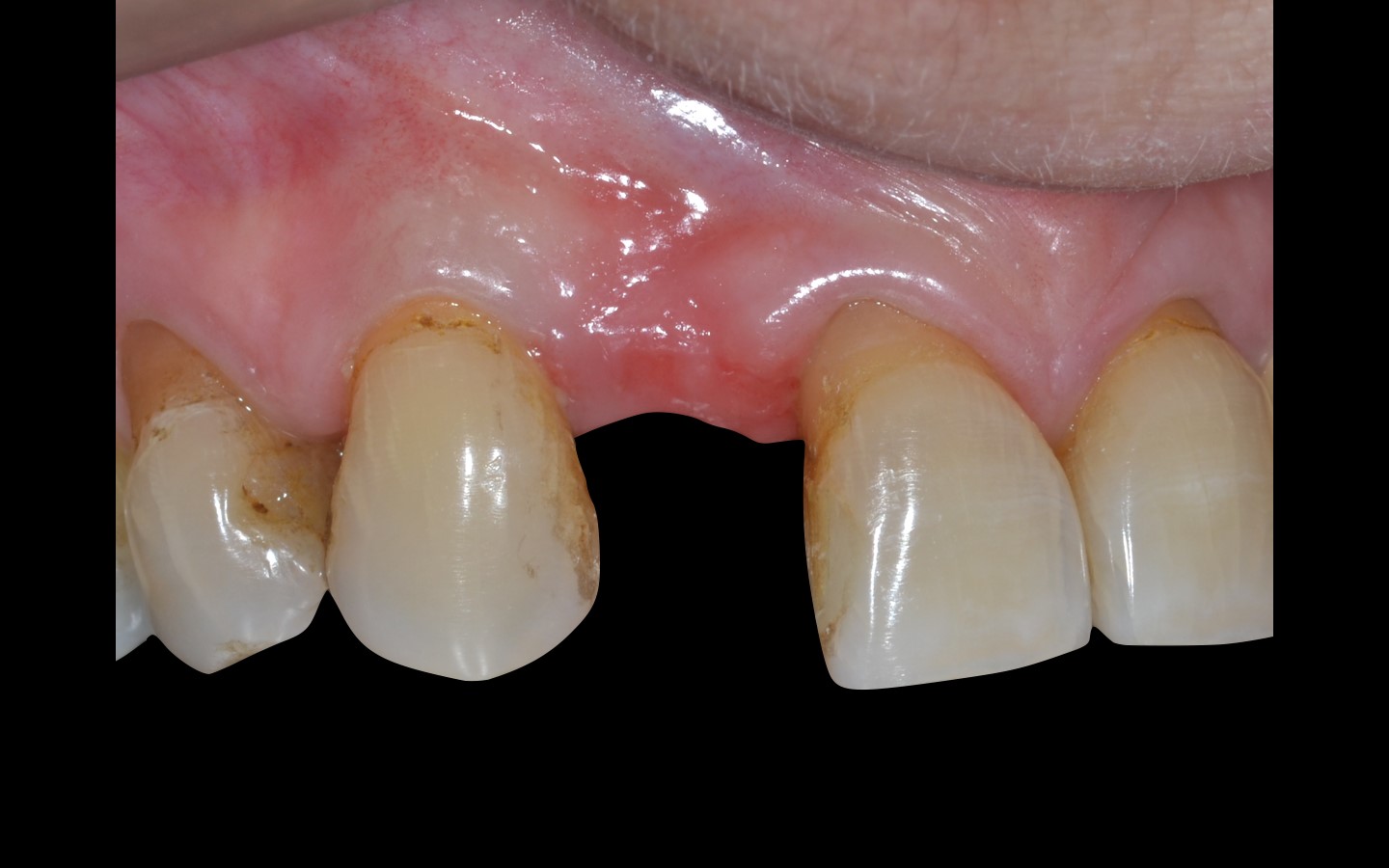 image3 - Reabilitação dento-alveolar com implante Arcsys, enxerto conjuntivo e substituto ósseo Nanosynt