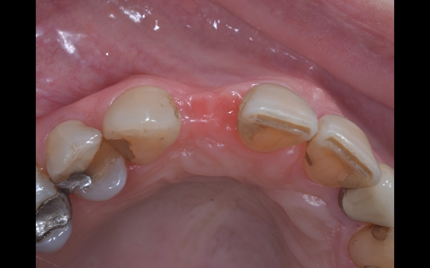 image4 - Reabilitação dento-alveolar com implante Arcsys, enxerto conjuntivo e substituto ósseo Nanosynt