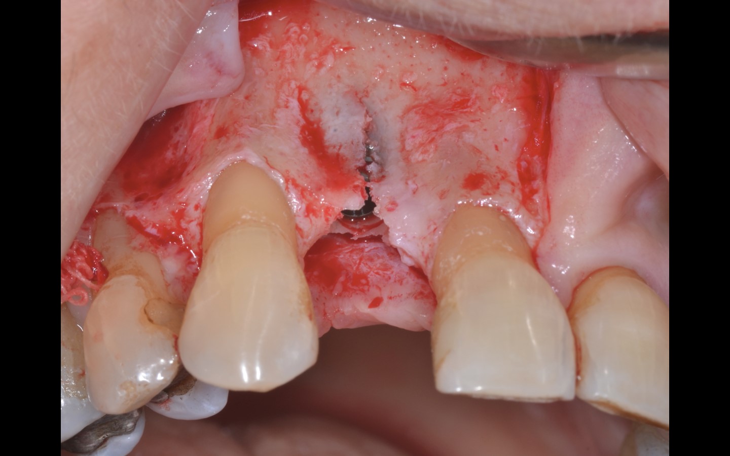 image6 - Reabilitação dento-alveolar com implante Arcsys, enxerto conjuntivo e substituto ósseo Nanosynt