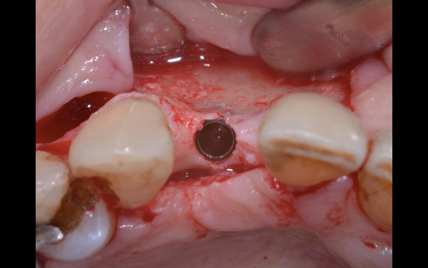 image7 - Reabilitação dento-alveolar com implante Arcsys, enxerto conjuntivo e substituto ósseo Nanosynt