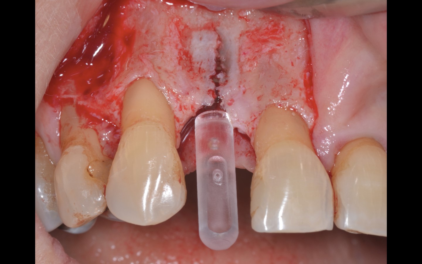 image8 - Reabilitação dento-alveolar com implante Arcsys, enxerto conjuntivo e substituto ósseo Nanosynt