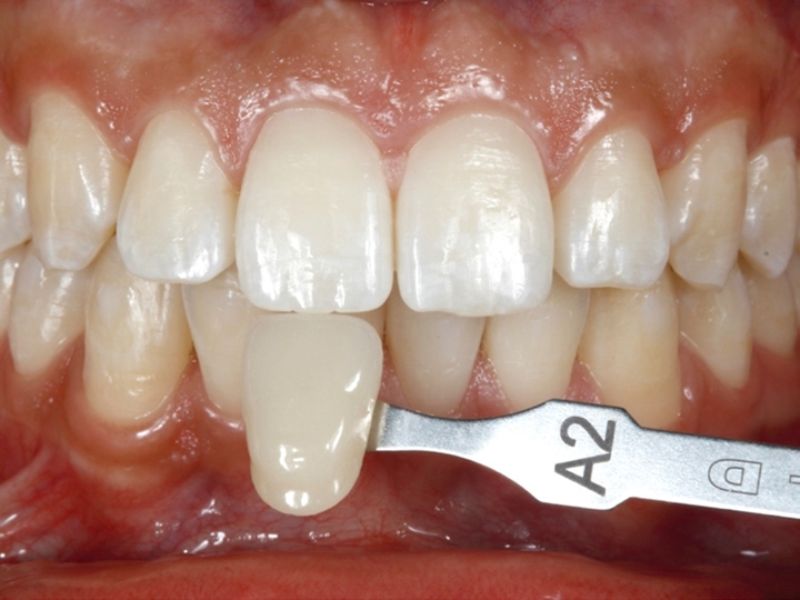 Fig. 3a – Coloração dos dentes superiores anteriores: A2 (Escala Vita).