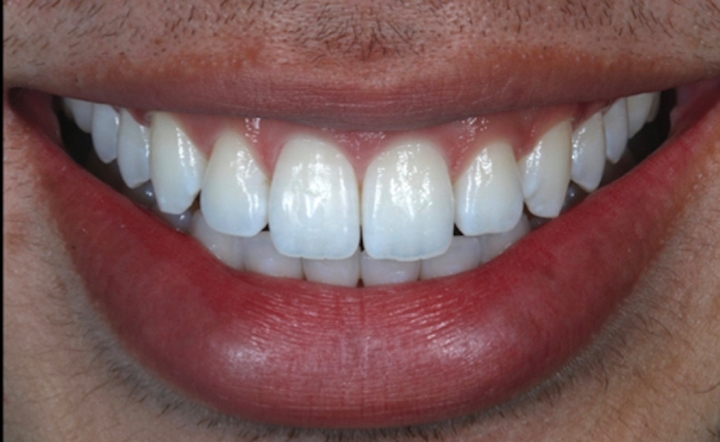 Figs. 6a e 6b – Aspecto final do paciente: foto frontal, sorriso frontal e lábios afastados.