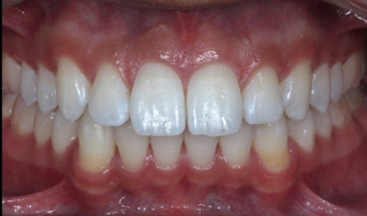 Figs. 6a e 6b – Aspecto final do paciente: foto frontal, sorriso frontal e lábios afastados.