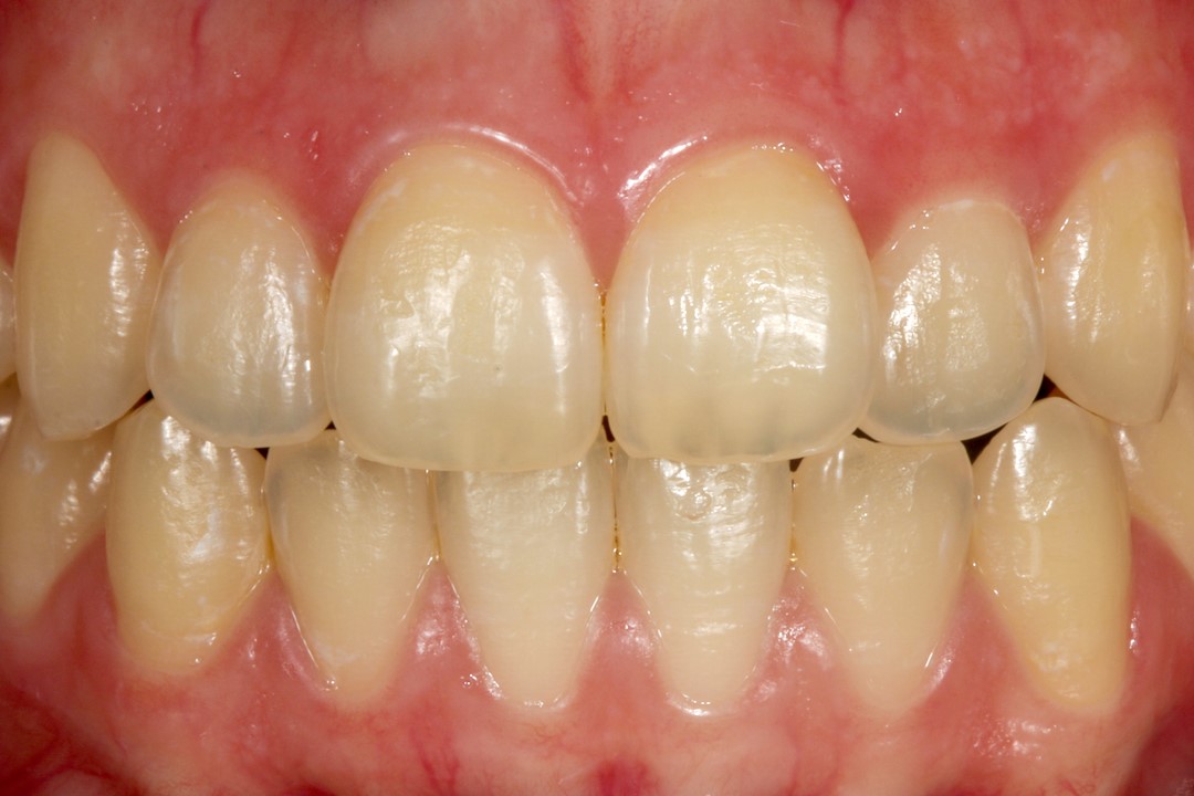 Fig. 1b – Aspecto inicial dos dentes apresentando amarelamento.