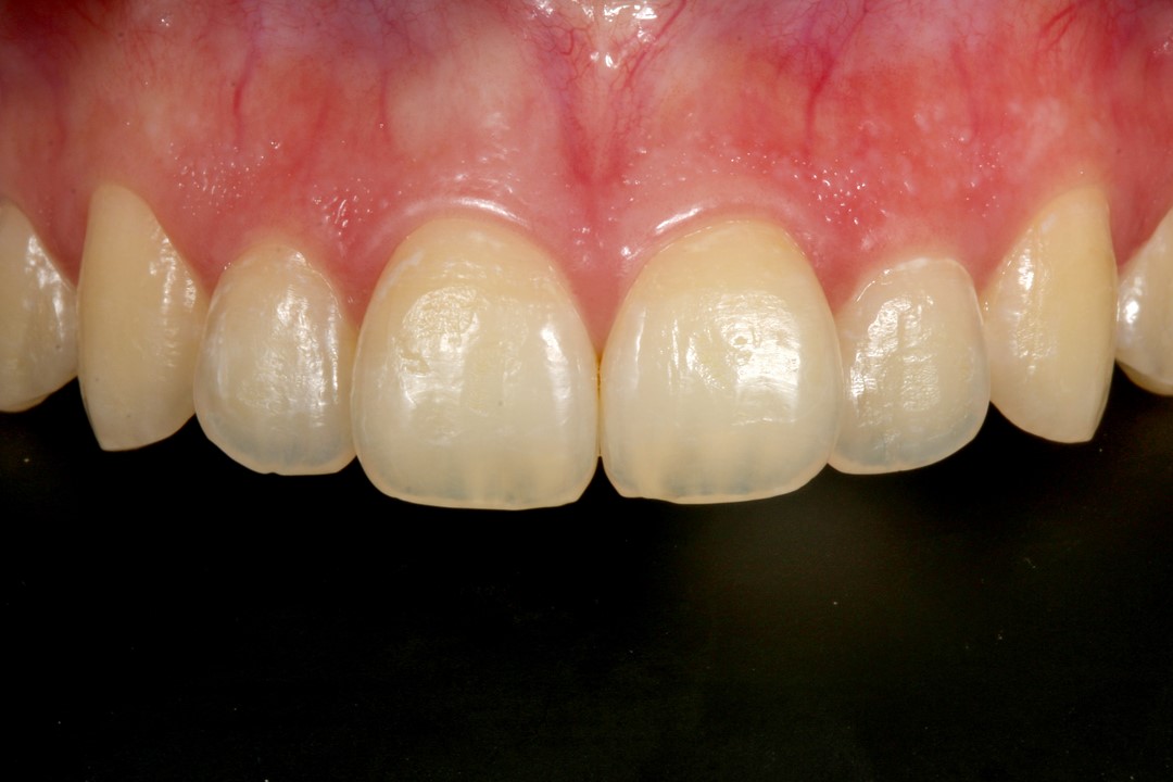 Fig. 1c – Aspecto inicial dos dentes apresentando amarelamento.