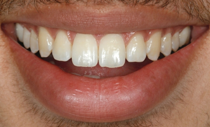 Fig. 1 - Aspecto inicial do paciente: foto frontal, sorriso frontal