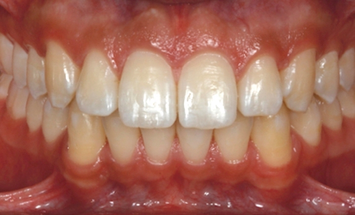 Fig. 2 - Aspecto inicial do paciente: lábios afastados