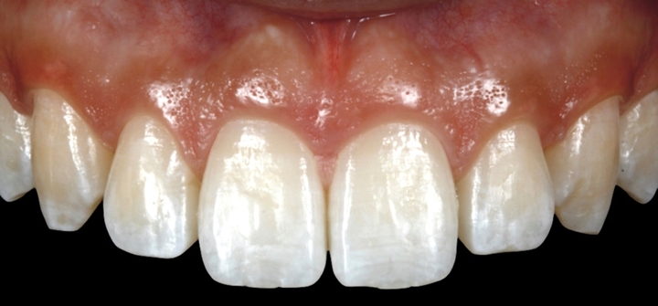 Figs. 2a a 2c – Dentes com contraste negro.