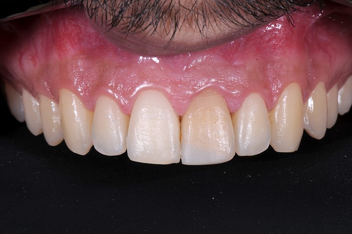 Fig. 5 - Vista aproximada dos dentes superiores, onde observamos que o dente 11 apresenta cor mais clara com grande discrepância quando comparado aos dentes posteriores e ao dente 21. A estratégia de clareamento deve ser criteriosa na tentativa de se conseguir máximo de equilíbrio final.