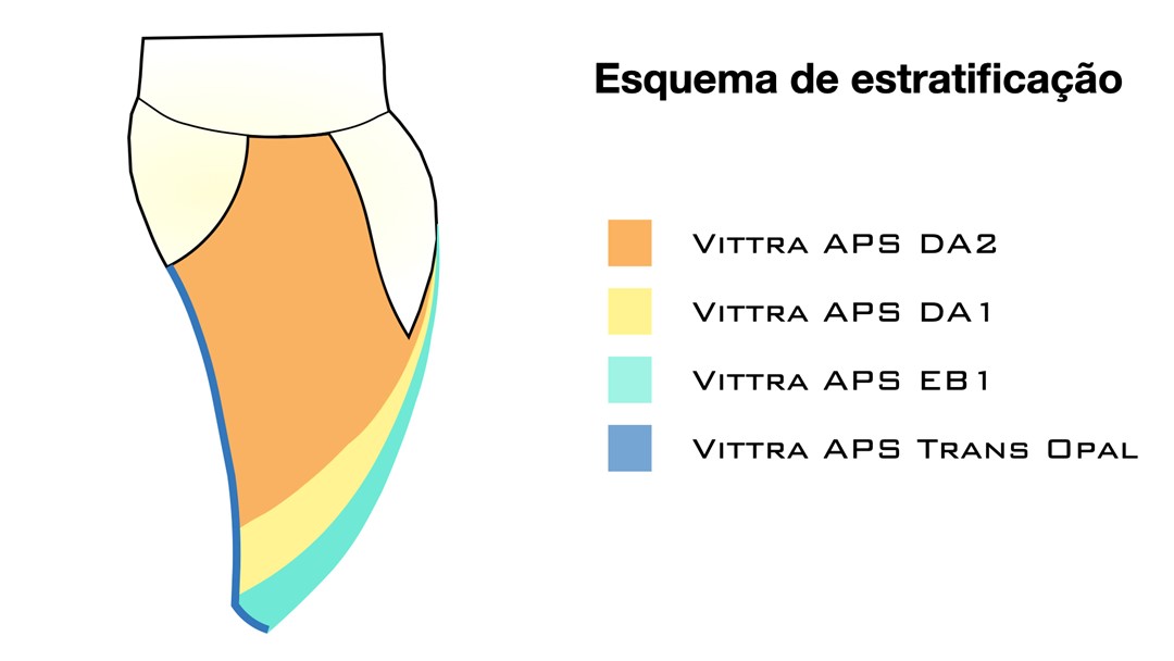Fig. 11 Ilustração representativa do esquema de estratificação
das massas de resina composta
Vittra APS.