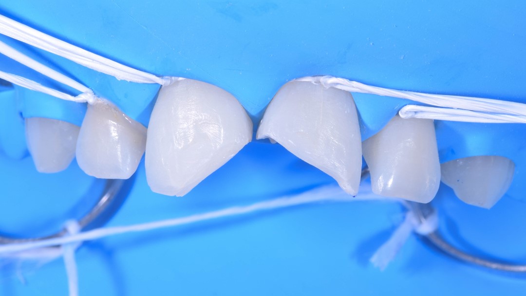 Fig. 12 Imagem frontal apresentando os dentes após a remoção de toda a
resina composta e tecido cariado. O
isolamento absoluto é fundamental
nestes casos.
