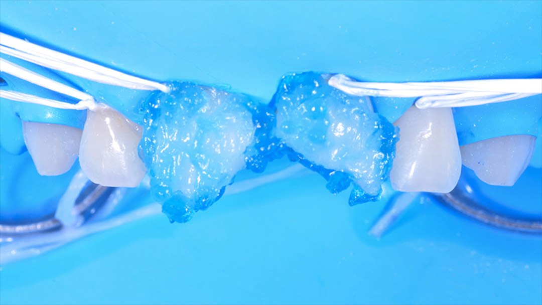 Fig. 14a Imagens frontais
apresentando o condicionamento
ácido com Condac 37 somente em
esmalte (a) e o aspecto dos dentes
após a aplicação do Adesivo Ambar
Universal APS juntamente com a
prova da guia palatina (b).