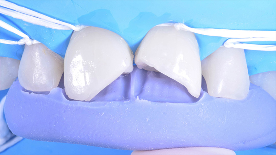 Fig. 14b Imagens frontais apresentando o condicionamento
ácido com Condac 37 somente em
esmalte (a) e o aspecto dos dentes
após a aplicação do Adesivo Ambar
Universal APS juntamente com a
prova da guia palatina (b).