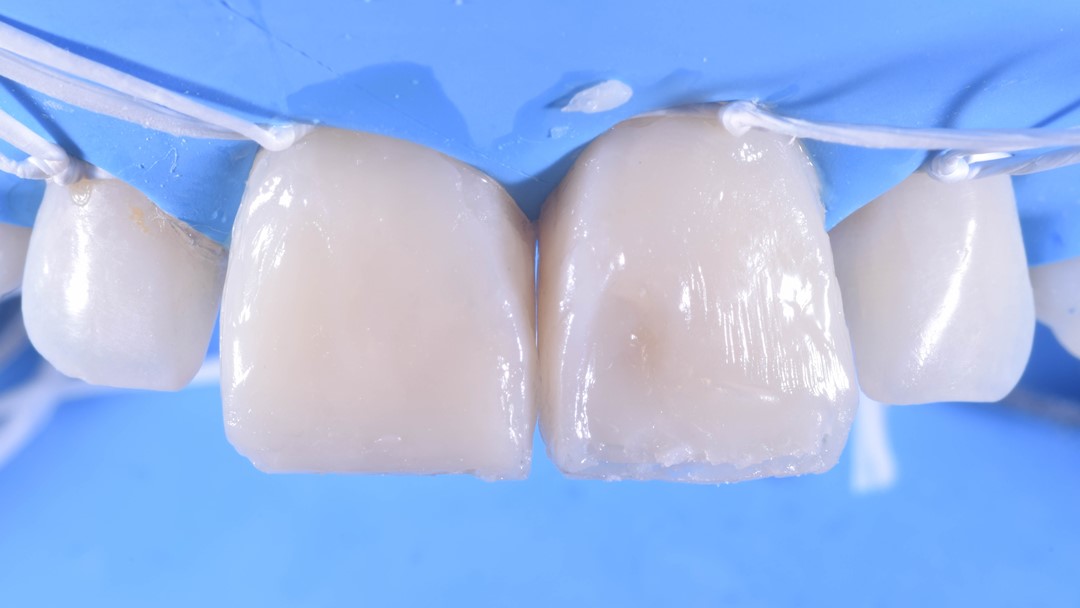 Fig. 17 Imagem frontal da reconstrução coronária com as massas de dentina DA2 (na base) DA1 (mais superficial). Observe que o dente 11 já apresenta a
estratificação das duas massas e o dente 21 apenas da massa DA2. 