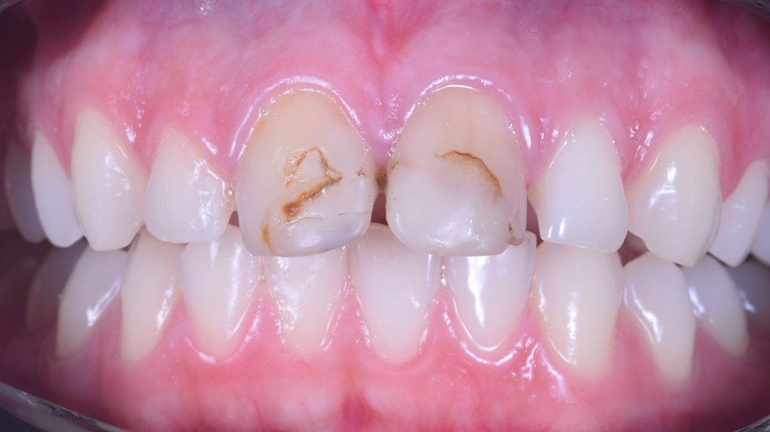 Fig. 2 Vista frontal inicial aproximada. Observe a alteração de forma e de cor dos dentes 11 e 21. 