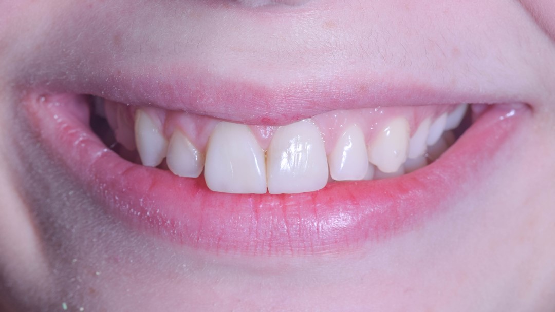Fig. 23 Imagem frontal final. A paciente foi encaminhada para o tratamento ortodôntico para tratar a Classe II Dentária
