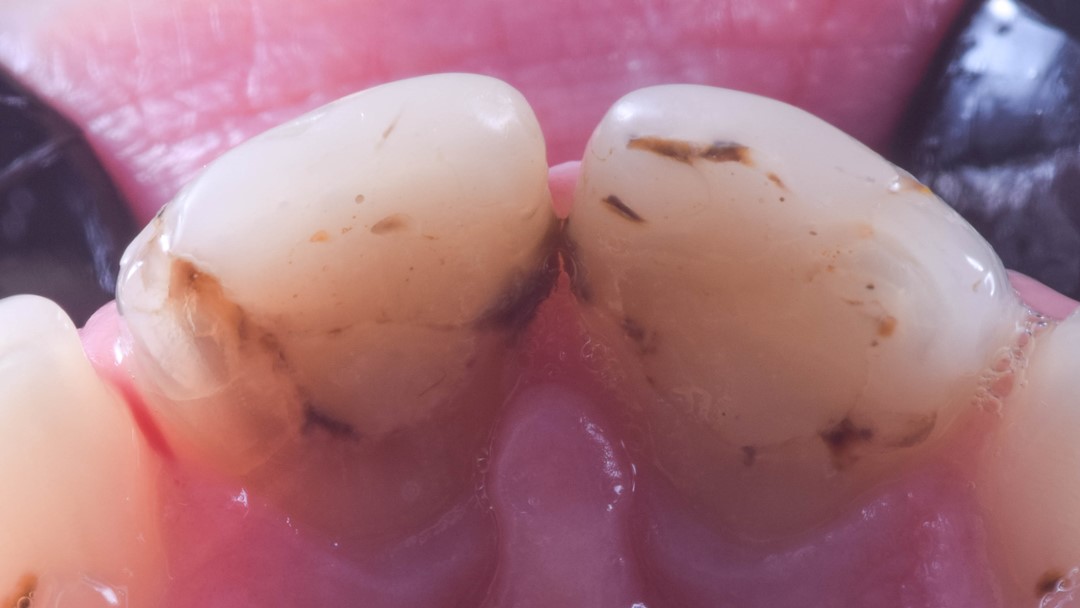 Fig. 3 Vista oclusal aproximada dos dentes 11 e 21. Observe o manchamento das restaurações. 