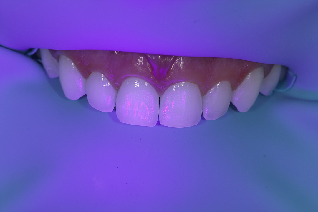 Fig 11 Luz ultravioleta