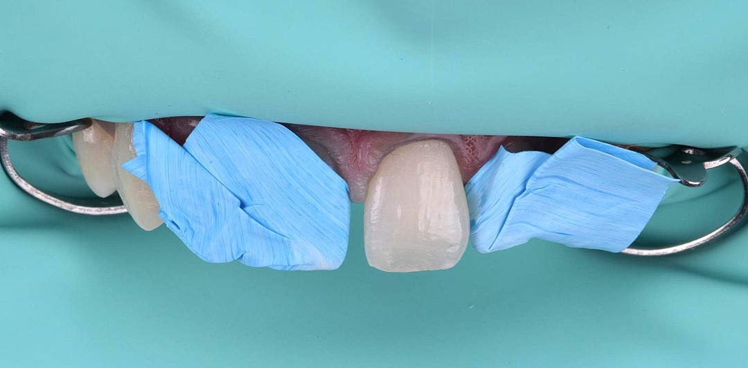 Fig 4 Proteção dos dentes adjacentes com TEFLON para realização de procedimento adesivo no dente 21
