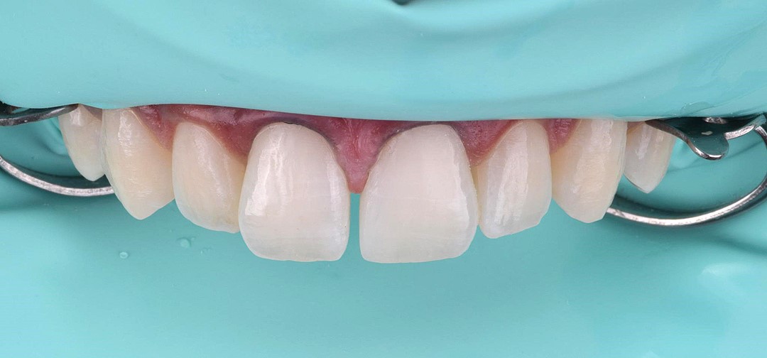 Fig 7 Restauração do dente 21 após acabamento com disco de lixa Diamond Pro