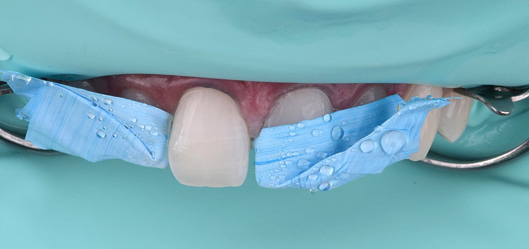 Fig 8 Dente 11 após lavagem do ácido fosfórico 37% Condac 37 para posterior aplicação sistema adesivo Ambar APS