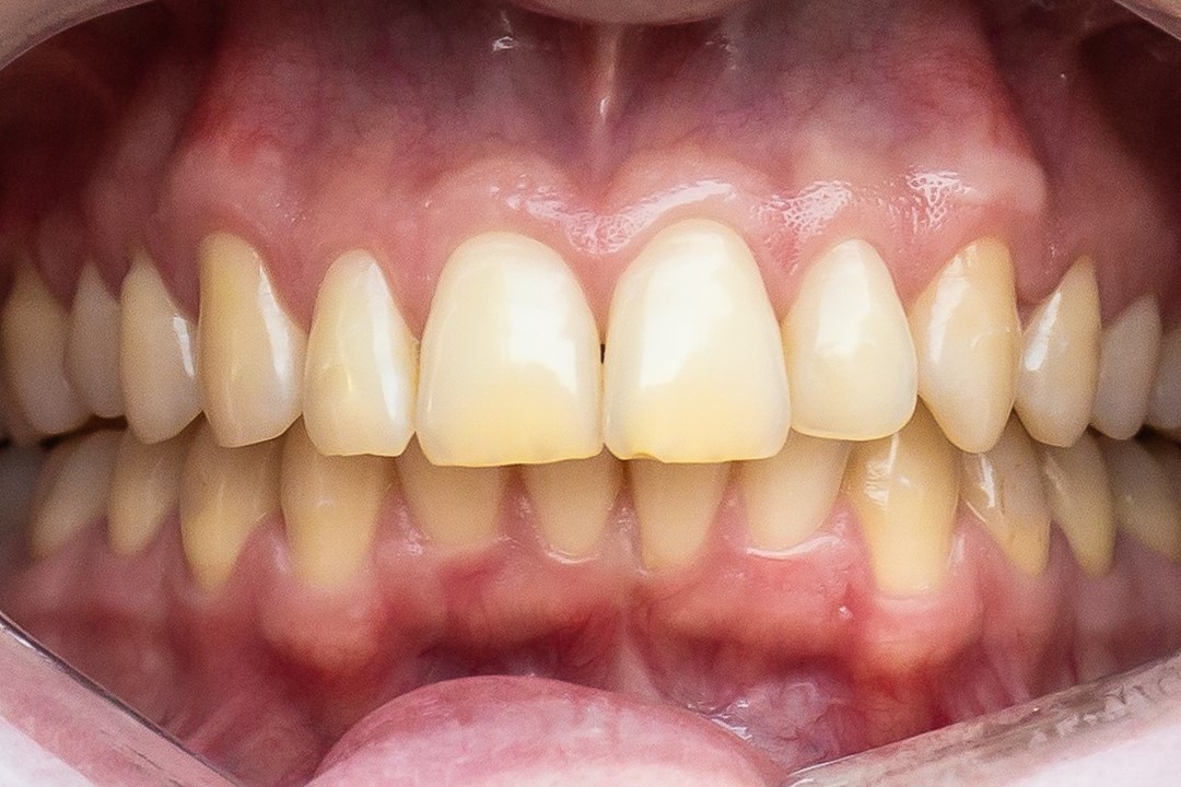 Fig. 1b Sorriso frontal e labios afastados - Clareamento de dentes vitais com White Class 7,5%
