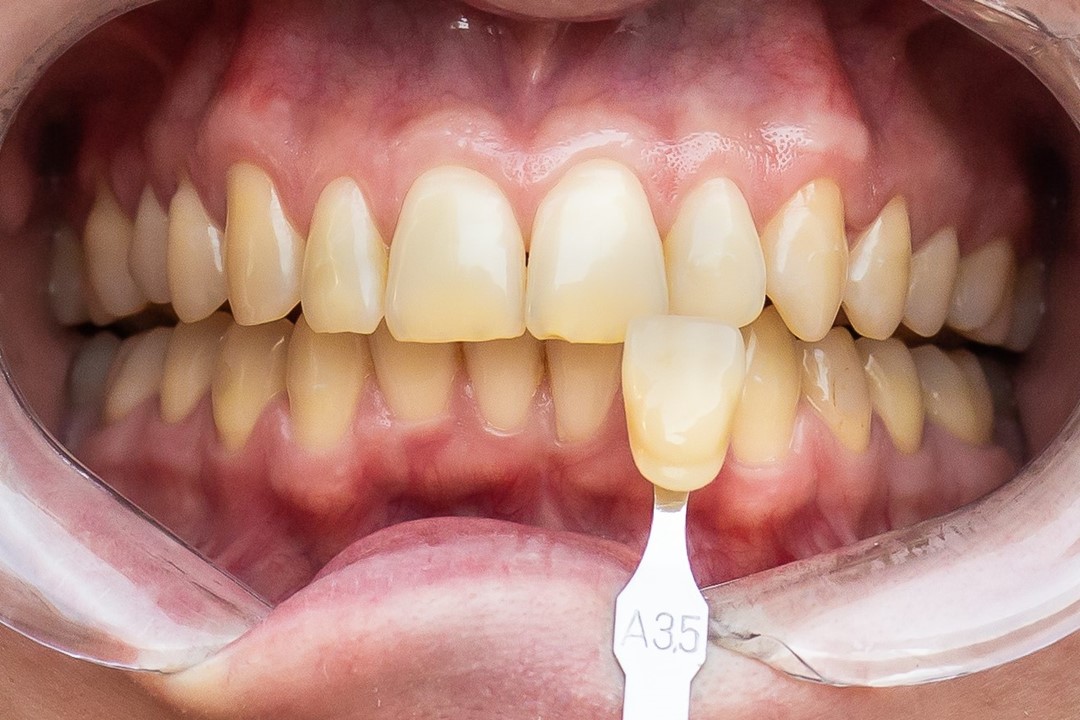 Fig. 1c Labios afastados tomada de cor A35 Vita - Clareamento de dentes vitais com White Class 7,5%