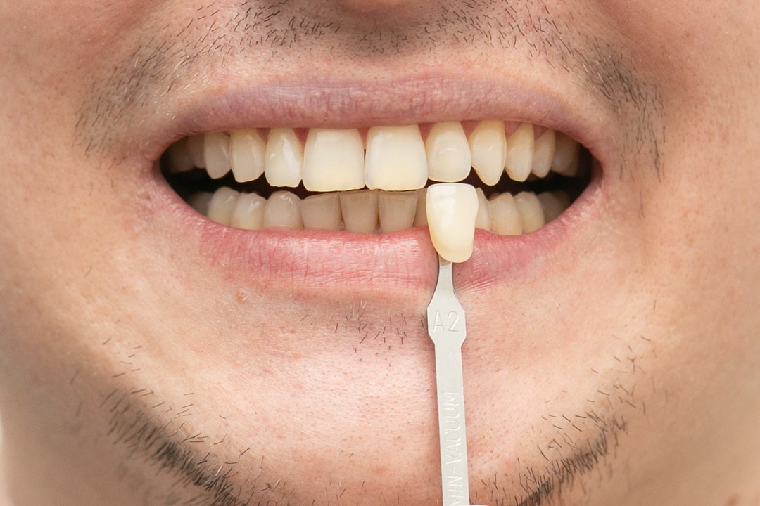Fig. 2a Aspecto dentario em 07 dias de acompanhamento A2 Vita - Clareamento de dentes vitais com White Class 7,5%