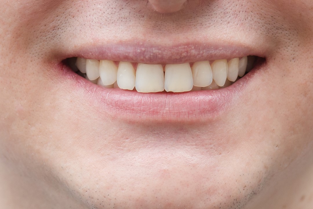 Fig. 3a Aspecto final do sorriso - Clareamento de dentes vitais com White Class 7,5%