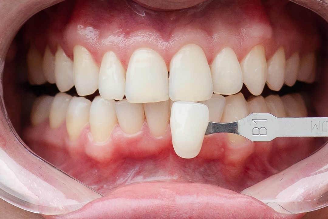 Fig. 3c Sorriso e labios afastados tomada de cor B1 Vita - Clareamento de dentes vitais com White Class 7,5%