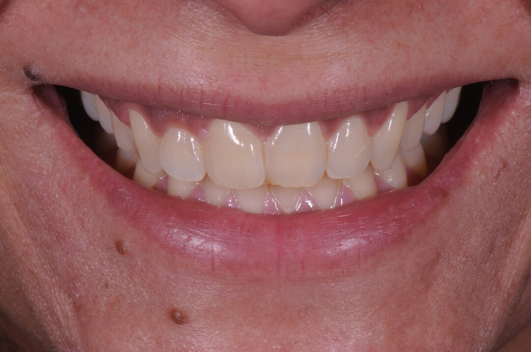 Fig. 1 - Sorriso frontal da paciente, evidenciando dentes com pequeno apinhamento, alteração de contorno gengival e cor com tonalidade mais saturada.