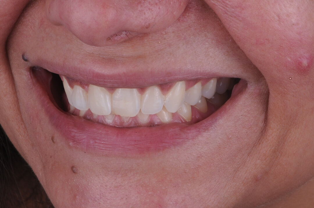 Figs. 10 - Com o clareamento houve melhora no aspecto de naturalidade,  mesmo com as pequenas imperfeições que apresentava nos dentes e na margem  gengival.