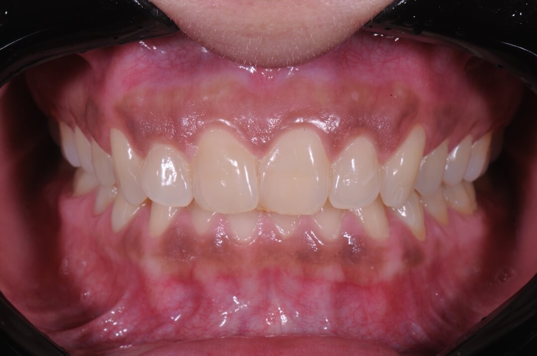 Fig. 2 - Vista frontal e intraoral mostra que a saúde gengival está correta, aspecto fundamental para início de qualquer tratamento odontológico