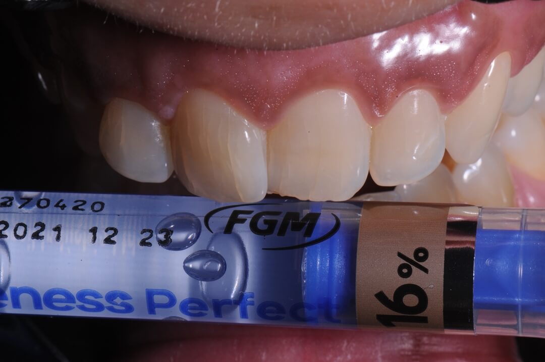 Fig. 6 - Foi selecionado gel Peróxido de Carbamida a 16% (Whiteness Perfect 16% - FGM) para a realização do clareamento. Nota-se na foto as trincas de esmalte, o que pode potencializar a sensibilidade durante o clareamento. Por isso, decidiu-se realizar uso de dessensibilizante dos dentes previamente ao procedimento.