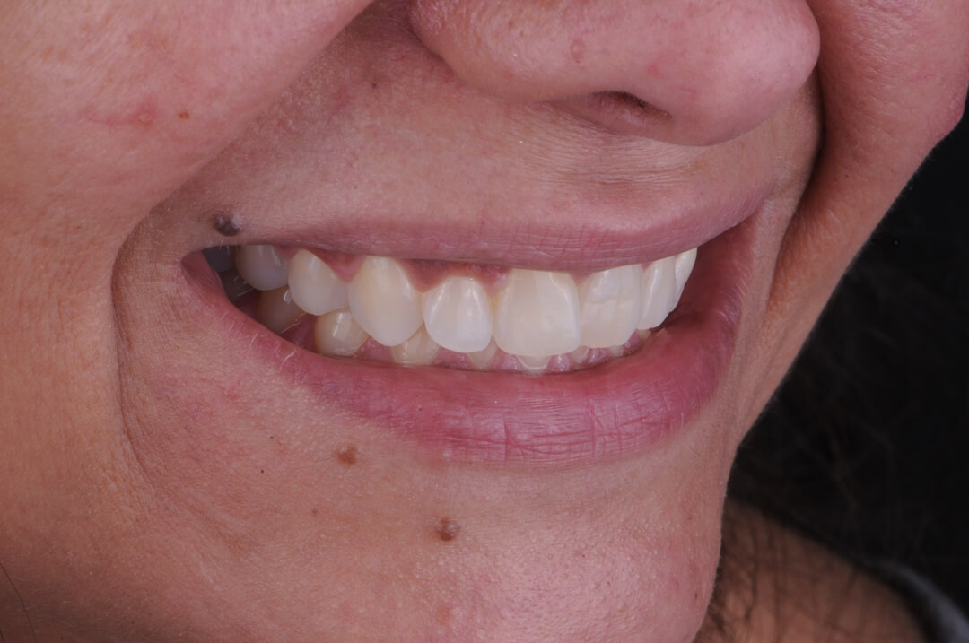 Figs. 9 - Com o clareamento houve melhora no aspecto de naturalidade,  mesmo com as pequenas imperfeições que apresentava nos dentes e na margem  gengival.