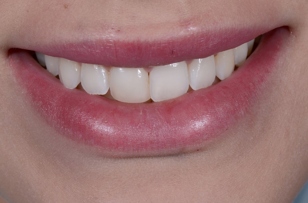 Fig. 1 Sorriso mostrando o dente 11 com alteração de cor e forma
