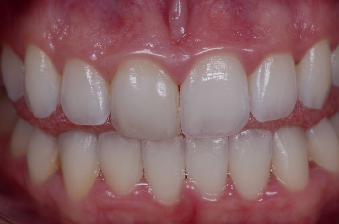 Fig. 2b Detalhe cromático e anatômico dos dentes com interposição lingual